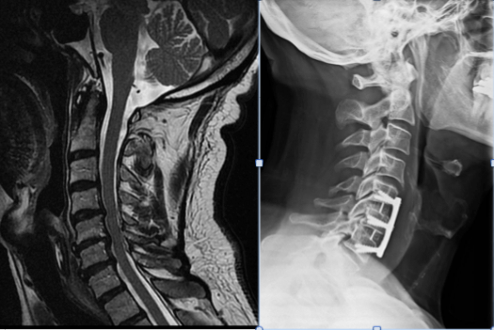 Mielopat A Cervical Tech Cuba