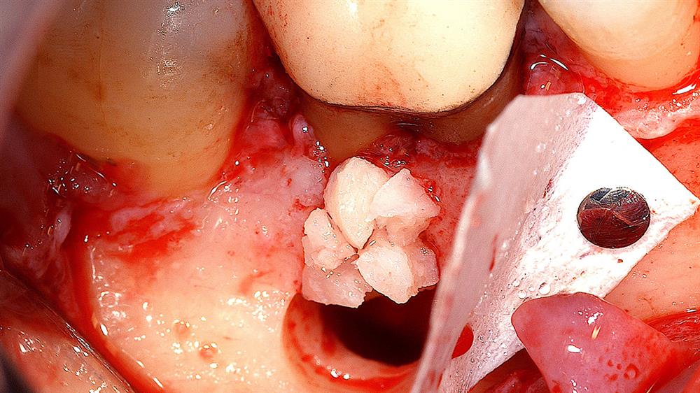 Capacitación Práctica en Endodoncia y Microcirugía Apical