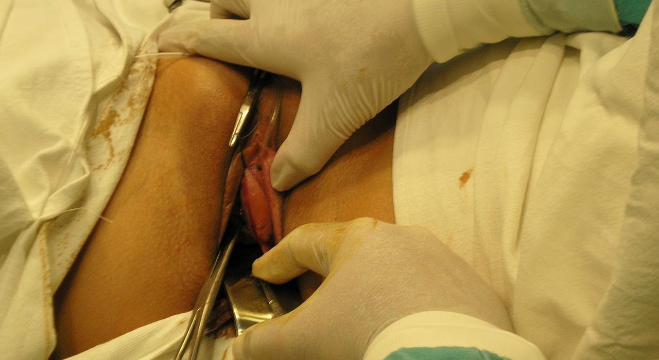 Protocolo de investigacion incontinencia urinaria postparto