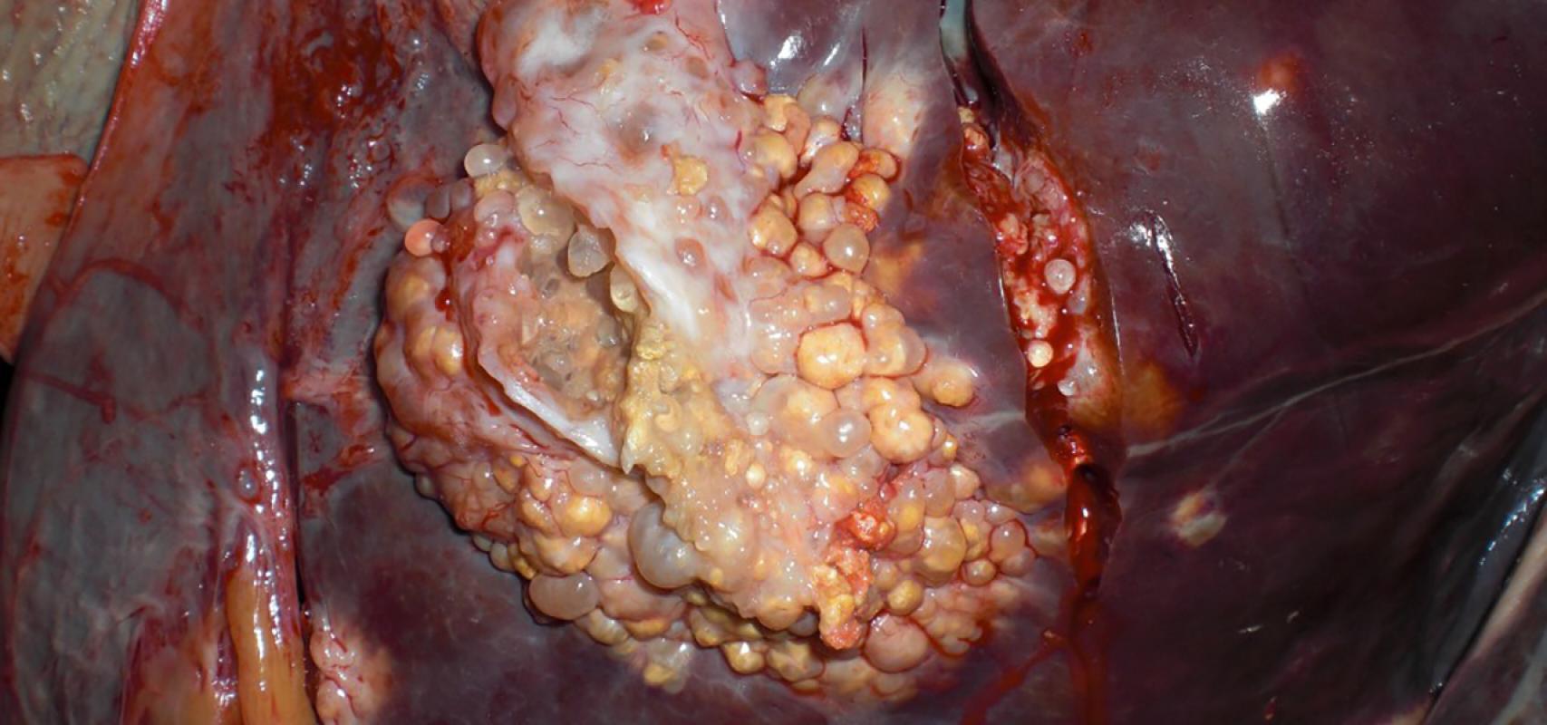 Carcinoma Hepatocelular