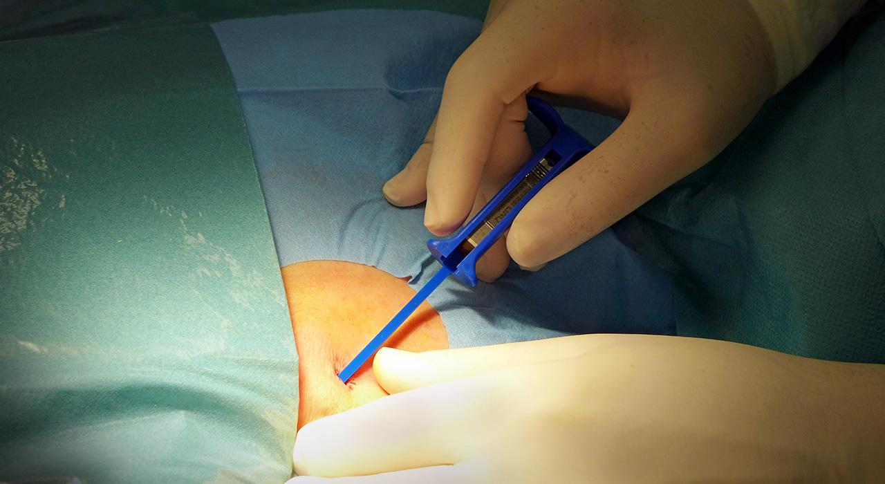 Complicaciones de la cateterización transeptal de la hipertensión