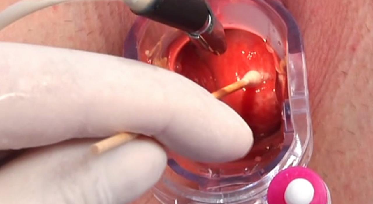 cancer de utero grado 2 tratamiento cancer de utero grado 2 tratamiento