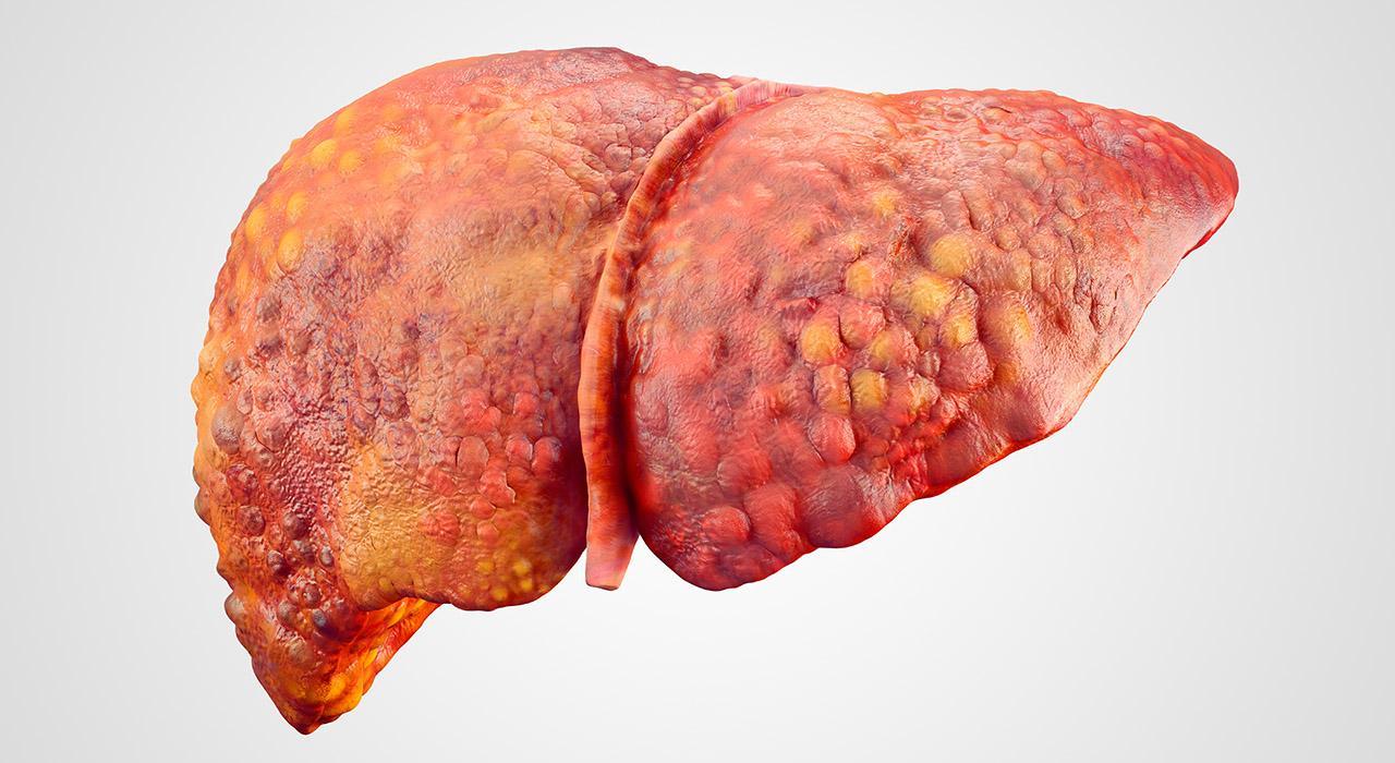 Informacion de hepatitis autoinmune