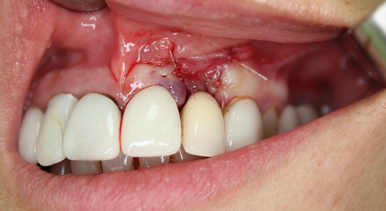 periodontitis y diabetes no inducidas por placa periodontitis y diabetes no inducidas por placa