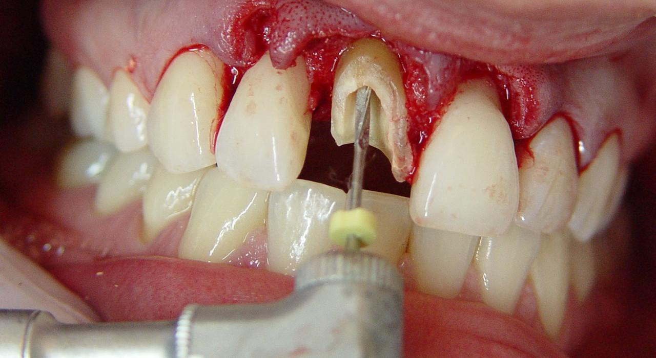 Maestría en Endodoncia y Microcirugía Apical