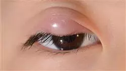 diplomado online actualizacion oculoplastica vias lagrimales