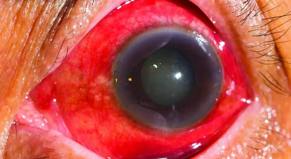 diplomado actualización en glaucoma