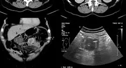 cursos tumores infrecuentes digestivos ginecológicos y hereditarios