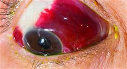 curso actualización en superficie ocular y córnea