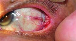 formacion actualización en superficie ocular y córnea