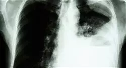 curso online tumores de la pleura mediastino y pared torácica el cáncer de pulmón como paradigma de los nuevos tumores raros pero no huérfanos