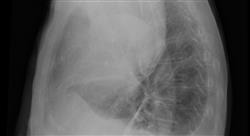 formacion tumores de la pleura mediastino y pared torácica el cáncer de pulmón como paradigma de los nuevos tumores raros pero no huérfanos