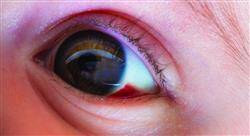 curso actualización en oftalmopediatría