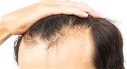 posgrado alopecia androgenética