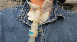 diplomado online Ostomías Respiratorias para Enfermería