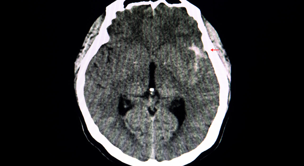 Diplomado en Hemorragia Subaracnoidea y Patología Aneurismática