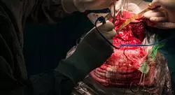 diplomado patologia vascular hemorragia subaracnoidea patologia aneurismatica intracraneal Tech Universidad
