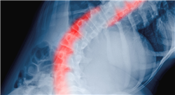 curso patología espinal tumoral fractura e infecciones