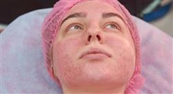 grand master medicina estética y tratamiento del acné