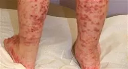 especializacion dermatología vascular pediátrica