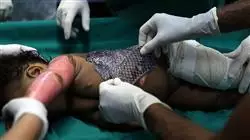 cursos tratamiento paciente critico pediatrico rehabilitacion grandes quemados