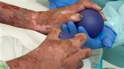 especializacion online tratamiento paciente critico pediatrico rehabilitacion grandes quemados