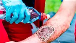 cursos manejo quirurgico fisiopatologia complicaciones grandes quemados
