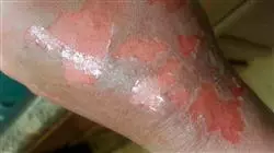posgrado complicaciones grandes quemado