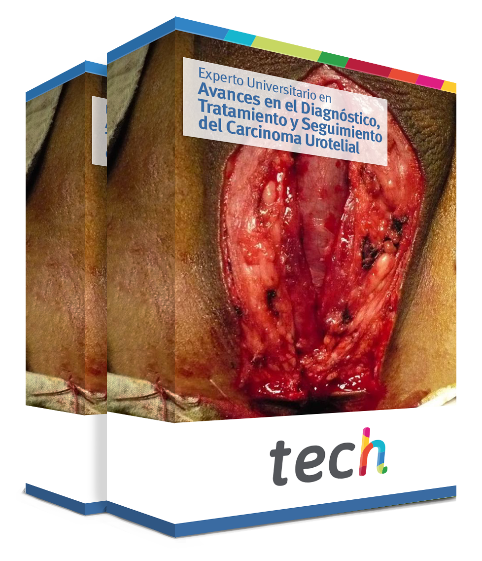 especializacion avances diagnostico tratamiento seguimiento carcinoma urotelial caja