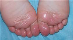 curso online avances en enfermedades ampollosas de la infancia