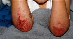 diplomado online avances en enfermedades ampollosas de la infancia