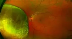 formacion patología tumoral de retina coroides y vítreo