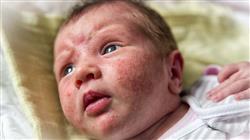diplomado acne neonatala