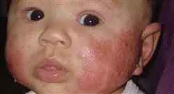 diplomado actualización en patología de los anejos cutáneos para dermatólogos