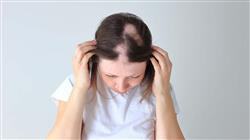 formacion alopecia infantila