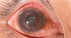 formacion enfermedades inflamatorias afectacion macula retina vitreo
