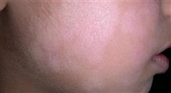diplomado actualización en dermatosis eczematosas y pápulo descamativas