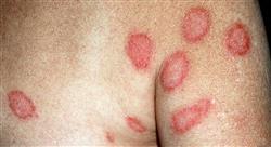 formacion actualización en dermatosis eczematosas y pápulo descamativas