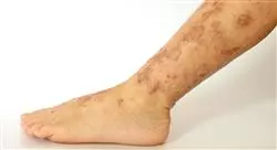 posgrado actualización en dermatosis eczematosas y pápulo descamativas