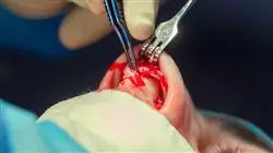 diplomado online cirugia estetica nasal