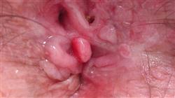 curso online cancer epidermoide