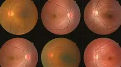 curso online capacitacion practica oftalmologia clinica