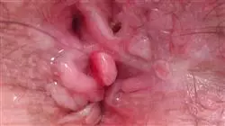 especializacion online suelo pelvico