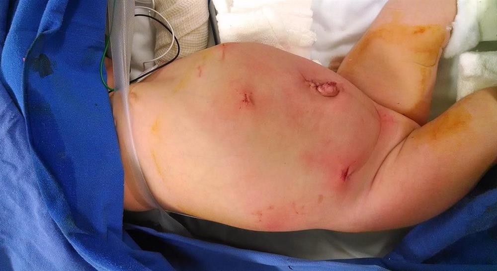 estudiar patología hepática y cáncer digestivo en pediatría