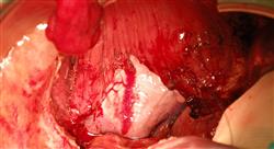 master semipresencial ginecologia oncologica cinco