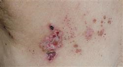master semipresencial dermatologia pediatrica uno