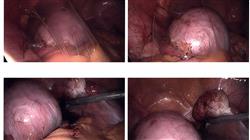 diplomado evaluacion clinica paciente endometriosis