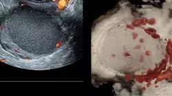 diplomado online evaluacion clinica paciente endometriosis