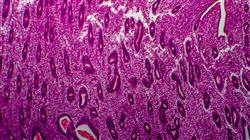 curso diagnostico endometriosis