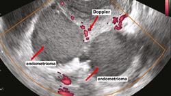 curso online diagnostico endometriosis